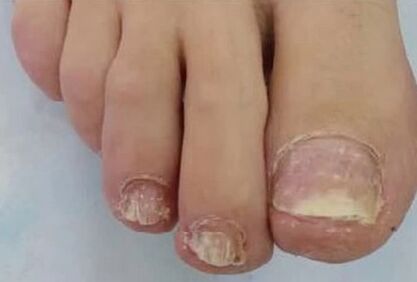 As unhas foram severamente afetadas pelo fungo