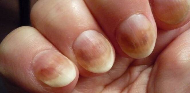 Infecção por micosis de unhas