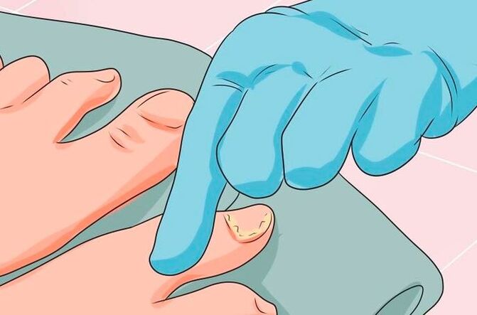 Os primeiros sinais de micose das unhas